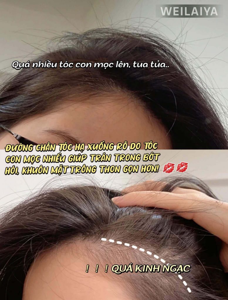 tác dụng trước và sau khi dùng serum weilaiya